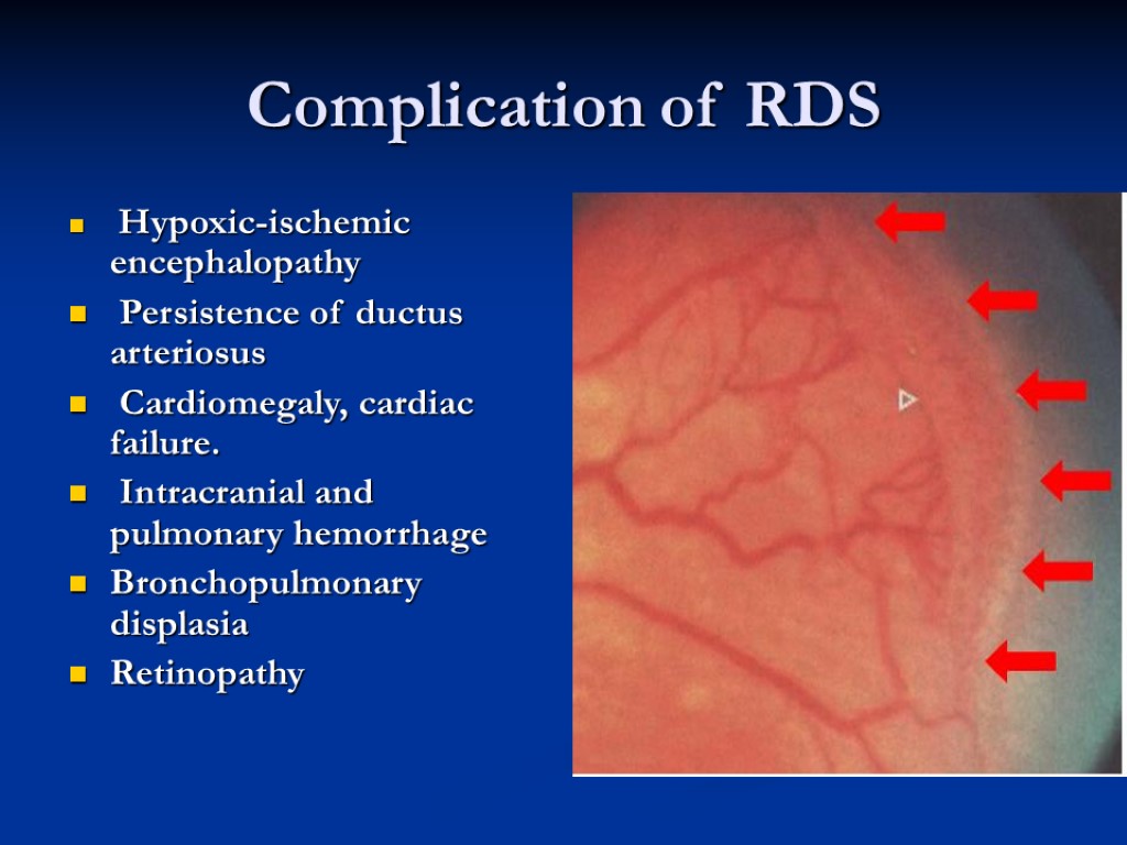 Complication of RDS Hypoxic-ischemic encephalopathy Persistence of ductus arteriosus Cardiomegaly, cardiac failure. Intracranial and